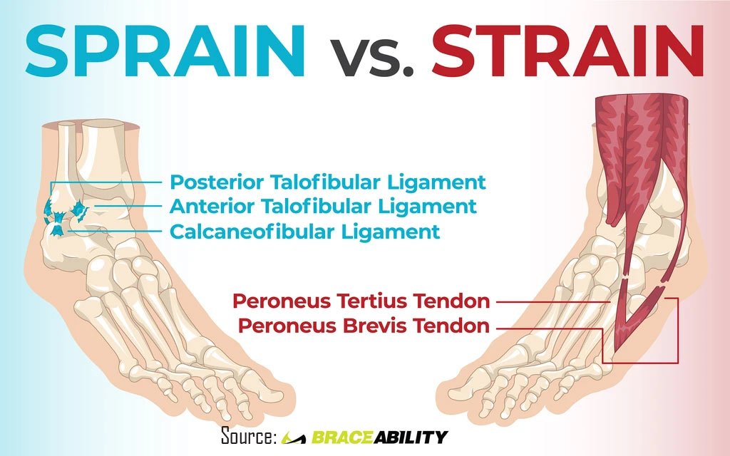 sprained ankle cedera bulu tangkis