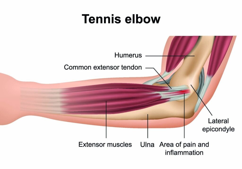 tennis elbow cedera bulutangkis